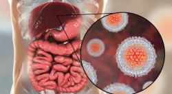 LA HEPATITIS SE HA VUELTO FRECUENTE EN VENEZUELA