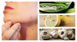 ¿MANCHAS DE ACNÉ? ELIMÍNALAS CON ESTOS REMEDIOS CASEROS