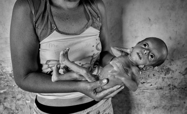xxniñodesnutricionxx.jpg